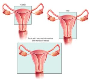 an01018 my00163 my00554 im03929 hdg7 hysterectomytypethu jpg