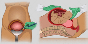 c section cesarean section 2 1